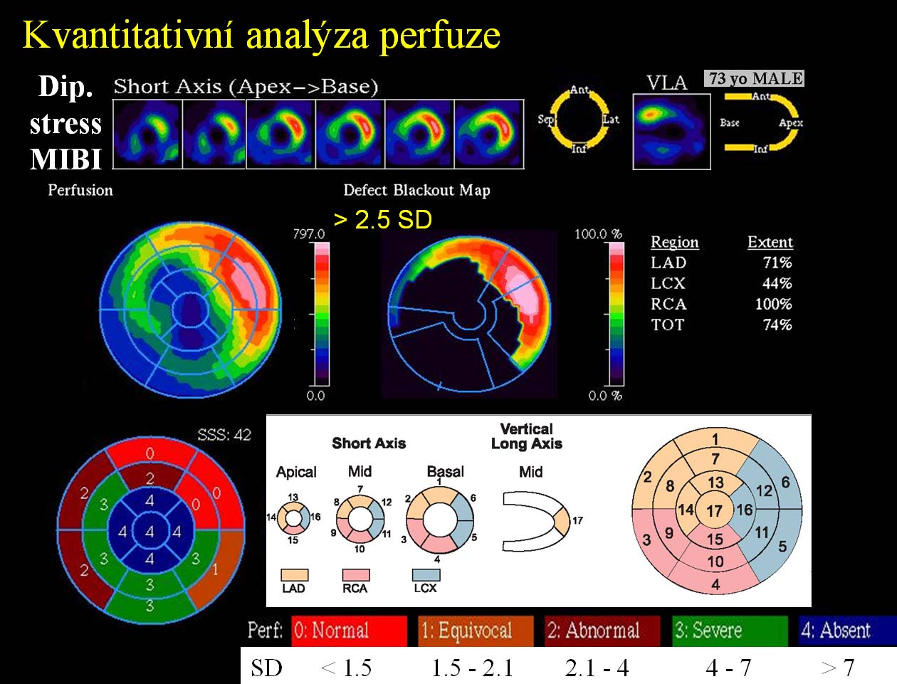 Obr. 16 Možnosti kvantifikace perfuzní abnormality u 73letého muže. Pomocí tzv.