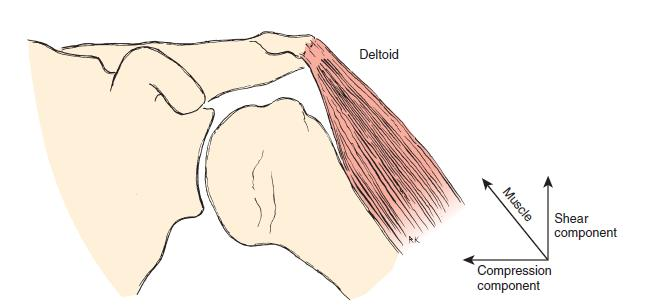 Obrázek 4: Silové působení svalů na kloubní povrch jamky lze rozdělit na dva na sebe navzájem kolmé vektory, kdy kompresivní složka působí přímo směrem na povrch jamky, zatímco střižná složka je
