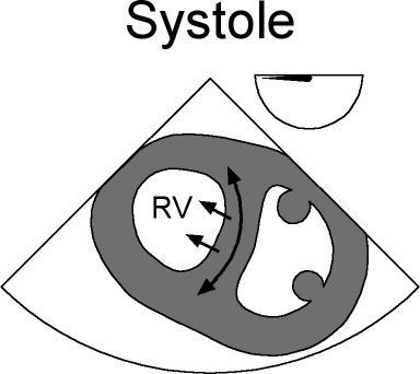 ACP CCP 4.) Increase of CVP decreases systemic preload 5.) altogether may produce decreased SV and CO pulsus paradoxus ddown Effect (Pp, BPs variation) 6.