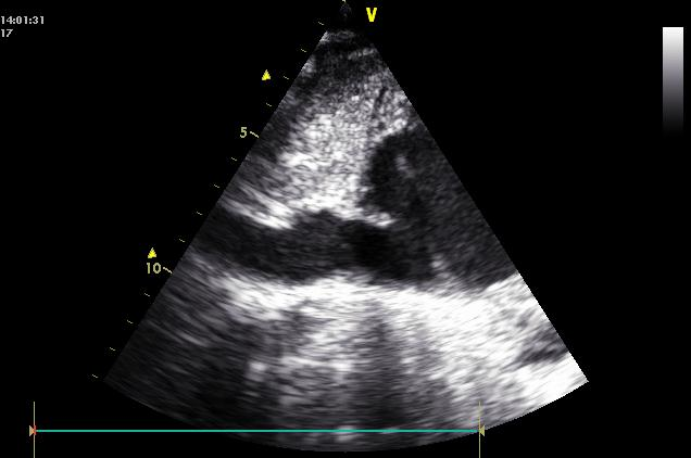 90 Subcostal 4C