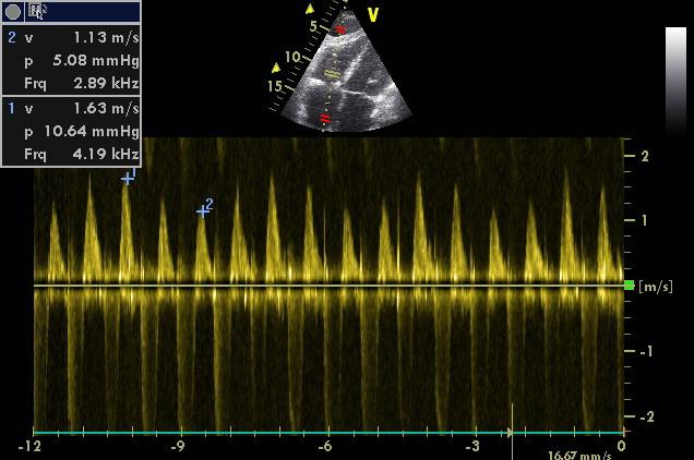 Tricuspid flow variation>25-40% may be present on IPPV with NO