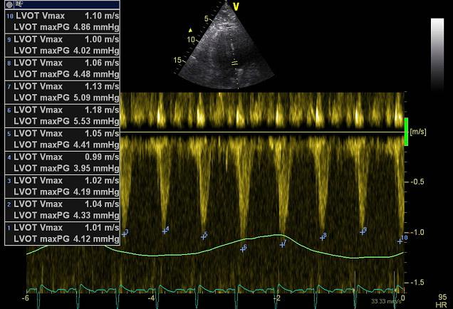 Impact of ventilator setting 1.) No spontaneous ventilation - VC-IPPV, PC-IPPV, deep sedation (GA), paralysis for the study purposes 2.