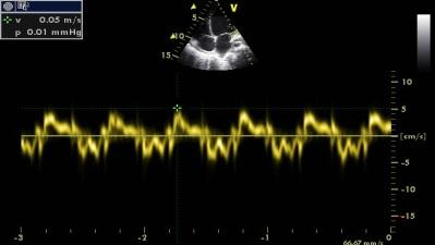 Echocardiographic parameters of preload 2D parameters LVEDA Interatrial septum IVC Doppler parameters Transmitral PW Doppler