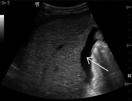 19 2. Ultrasonografické vyšetření Úvod Ultrasonografické vyšetření patří mezi standardní vyšetření při poranění břicha a pánve.