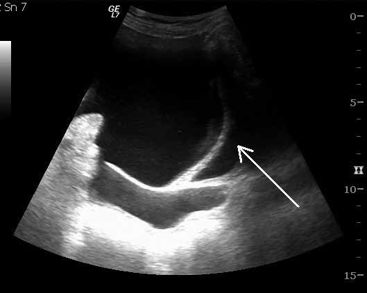 20 Diagnostika zlomenin pánve a acetabula b c Obr. 2.1.