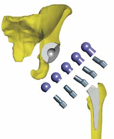 Popis implantátů Operační postup Instrumentárium Katalogová nabídka 7. Druhé zkušební zakloubení Po definitivním usazení dříku následuje druhá zkušební fáze operace.