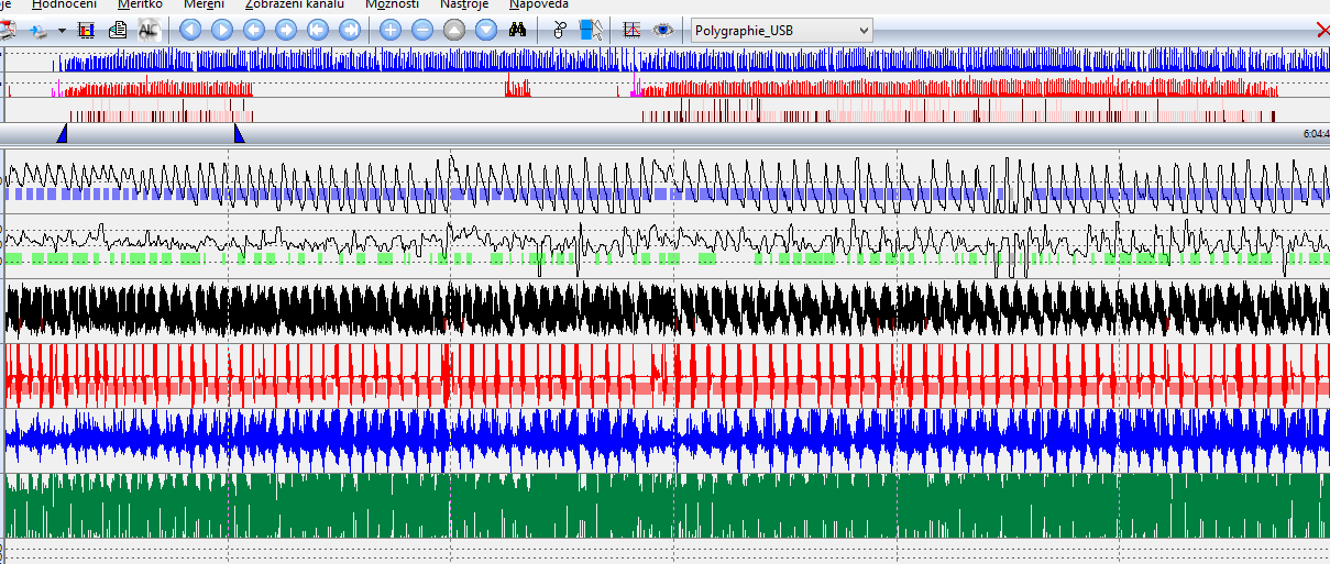 Kazuistika 3 Polygrafie AHI: 83,4 (81,4 OA/hod; 2 HY/hod; 0 MA/hod; 0 CA/hod). ODI: 82,2 min.