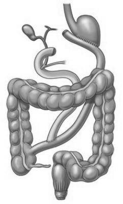 Obrázek 4 Biliopankreatická diverze se zachováním duodenální pasáže Zdroj: http://www.vstj.cz/obezicentrum/?