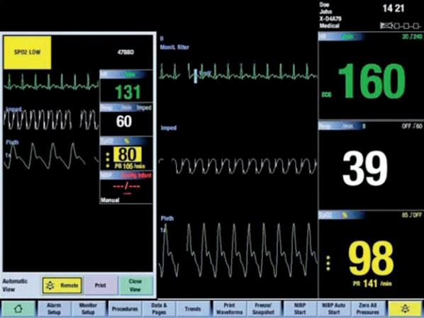 Sledování AS během resuscitace Poslech, pulzní oxymetrie + třísvodové EKG