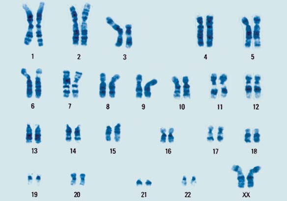 Obr. 9. Karyotyp nádoru pacienta se světlobuněčným RK. Na obrázku je jasně patrná delece krátkého raménka chromozomu 3 [22].