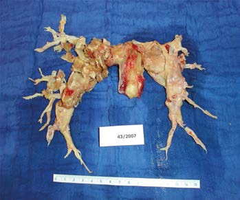 Obr. 3. Terapeutický algoritmus chronické plicní hypertenze Obr. 4. Endarterium odstraněné u nemocného s těžkou chronickou tromboembolickou plicní hypertenzí při endarterektomii plicnice.