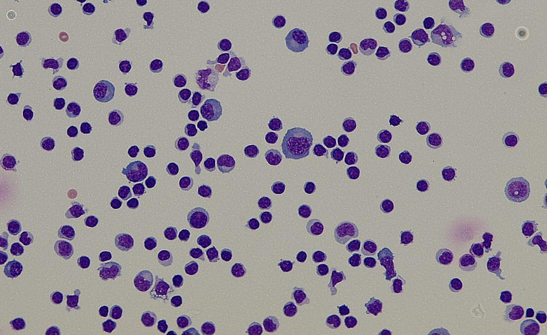 Neuroborelioza ID 2795/2015: Elementy CSF: 464 /ul, Erytrocyty CSF: 5 /ul V likvoru serozně zánětlivá celulizace ve smyslu lymfocytární pleocytózy s plazmocytární reakcí, elevace pro boreliovou