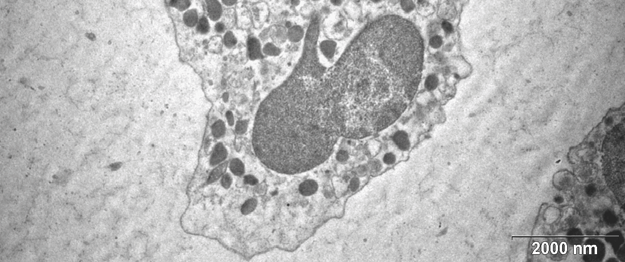 Využití metod detekce apoptózy a nekrózy neutrofilních granulocytů krve skotu in vitro 111 3: Apoptotický neutrofil ve stadiu zeiózy s tvoĝícími se apoptotickými tčlísky (šip Panoptické barvení dle