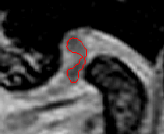 a) b) c) Obr. 14 Vybrané řezy MR snímků hlavy v oblasti čelistního kloubu, a) - c) vybrané 3 řezy čelistním kloubem. a) b) c) Obr.