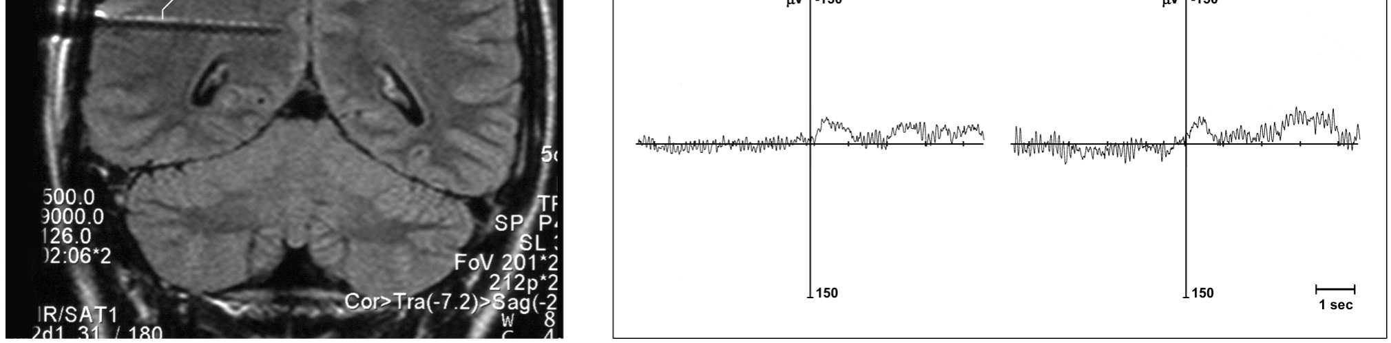 movement; β ipsi - beta ERD ipsilateral to the movement; n.p. not performed; n.