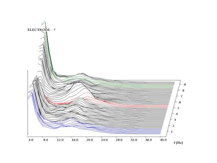 b/ kontinuální tzv. wavelet transformace c/ definováním frekvenčního pásma relativně k výkonovému maximu, vrcholu (peak) celé frekvenční spektrální analýzy (Obrázek č. 8) Obrázek č. 8 2.4.