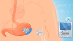 Miniaturizace, elektronika Plovoucí kapsle kapslová endoskopie Antiobezní pilulky Indikace = vlčí hlad Stimulace svalů žaludku Tzv.