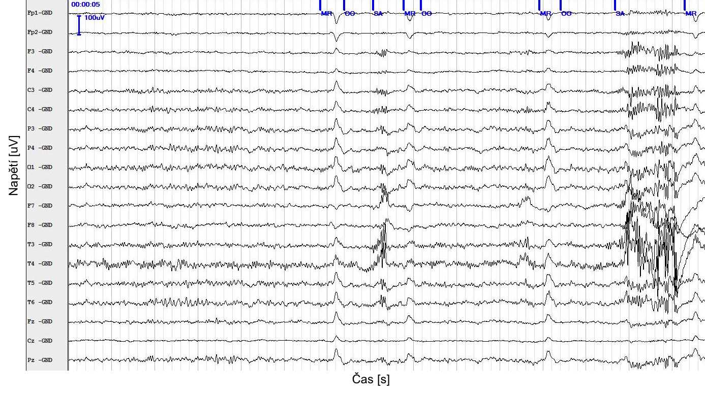 Obrázek 19: Ukázka EEG záznamu s artefakty. Jednotlivé artefakty jsou označeny: OO(Otevřené oči), MR(Mrknutí) a SA(Svalová aktivita). Značky jsou umístěny na horním řádku, kanál Fp1.