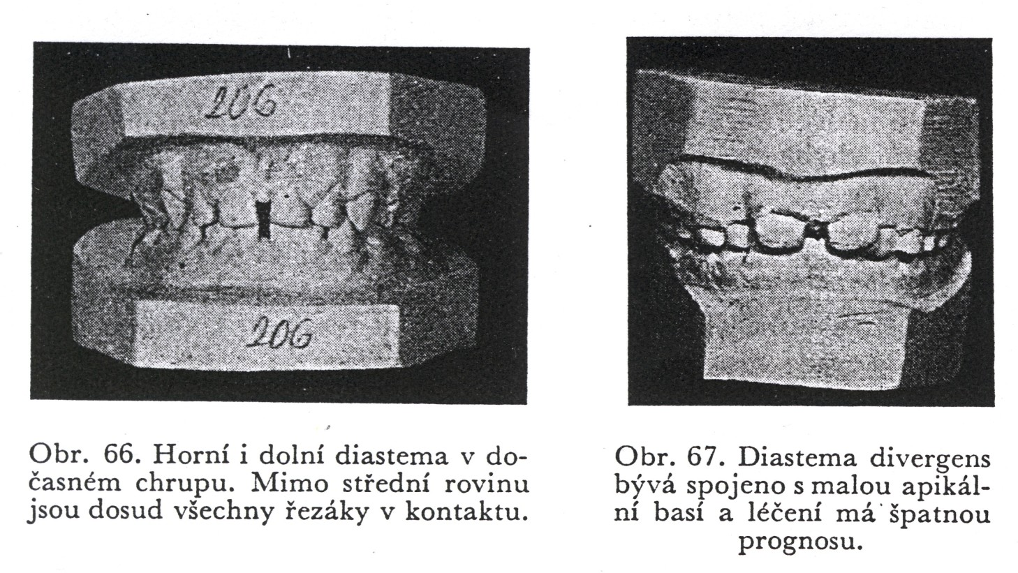 Diastema Diastemou nazýváme na rozdíl od fylogenetického pohledu na vývoj chrupu, kde tak nazýváme mezery v horní a dolní čelisti do nichž zapadají špičáky a tak zamykají čelisti