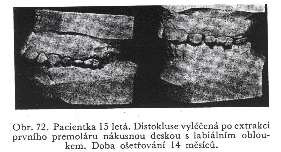 Distokluse Klasické znaky distokluse jsou tyto: dolní čelist je v poměru k horní čelisti v retrusi, což se projevuje tak, že první stoličky jsou proti horním posunuty distálním směrem.