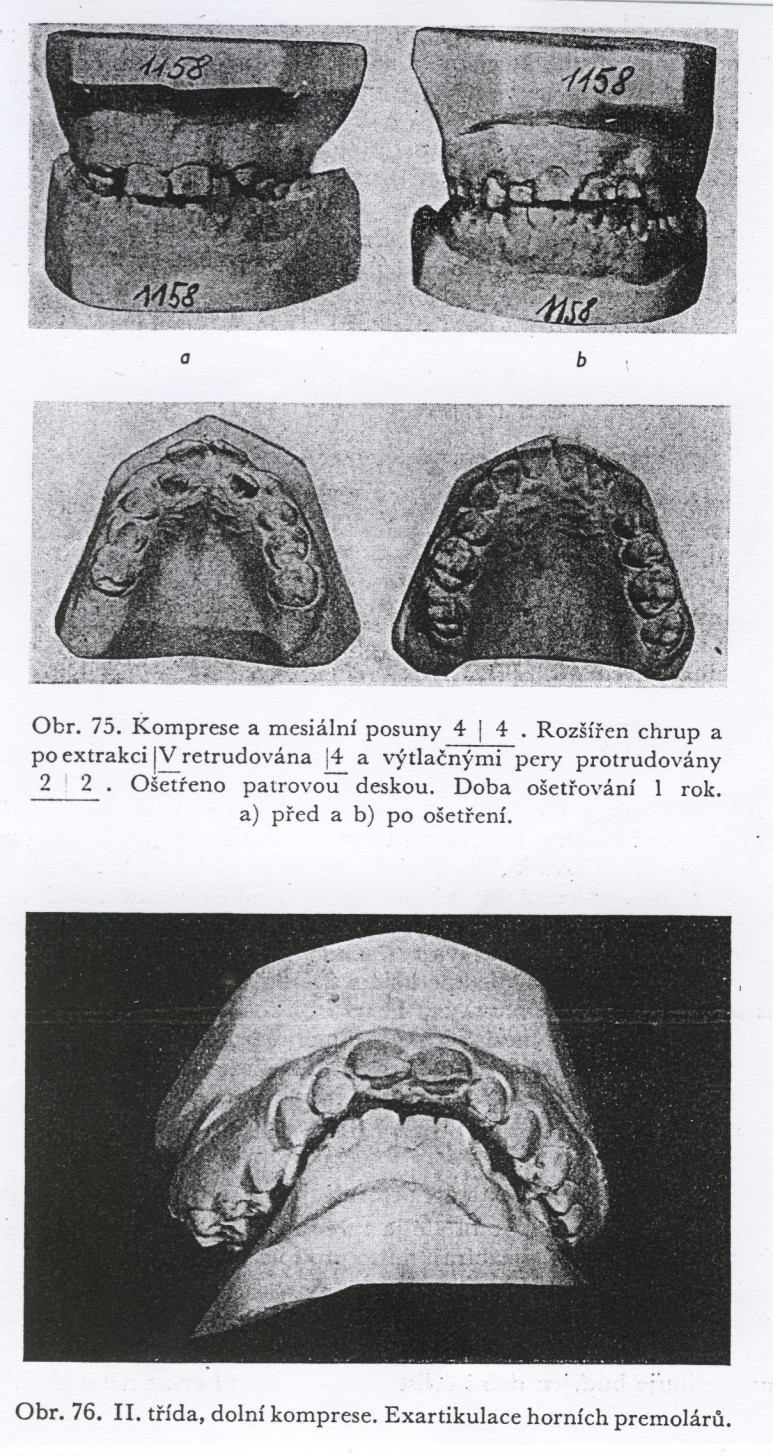 Stěsnání zubů Je to častá nepravidelnost chrupu a nejčastěji postihuje řezáky a špičáky.