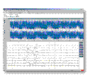 Obr. 3: Jednotlivé typy aeeg monitorů 1.