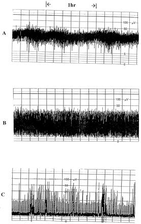 Hodnocení základní aktivity Původní klasifikace dle al Naqueeba hodnotila křivky podle amplitudy základní aktivity, kdy byly rozlišovány 3 základní typy křivek [2] (obr. 5): 1.