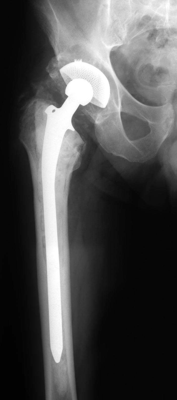 63/ Obr. 4. Průřez femurem po implantaci cementovaného dříku CF 30 Obr. 6. Extrahovaný dřík CF 30 i s cementovým toulcem Obr. 5. Kontrolni rtg-snímek 5 let po implantaci s uvolněným dříkem CF 30 Obr.