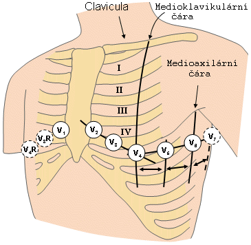 Obrázek 4: Zesílené končetinové svody podle Goldergera. Unipolární hrudní svody (též prekordiální) se značí V 1, V 2, V 3, V 4, V 5 a V 6.