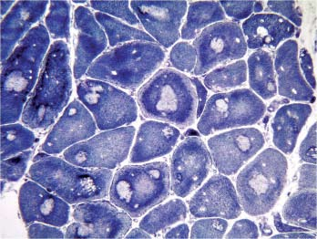 Hlavná téma 195 Obrázek 1. Central core disease. V cytoplazmě svalových vláken jsou v centru i periferněji patrny okrouhlé defekty s chyběním reakčního produktu.