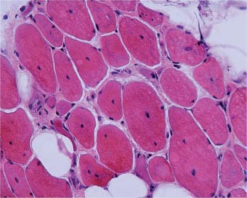 Kromě myopatického kolísání velikosti svalových vláken a zmnožení vazivově tukové tkáně v intersticiu je zřetelné centrální uložení jader ve svalových vláknech skupiny core myopatií.