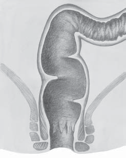 Anatomické poznámky 11 2 Anatomické poznámky Rektum je anatomicky definováno jako terminální část tlustého střeva, sahající od rektosigmoideální junkce v úrovni třetího sakrálního obratle k