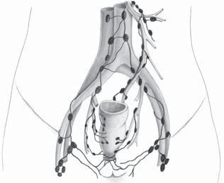 14 Komplexní léčba nádorů rekta paraaortální uzliny aorta vasa mesenterica inf. vasa iliaca int. vasa iliaca ext. Obr. 2.4 Lymfatické šíření karcinomu rekta ganglií.