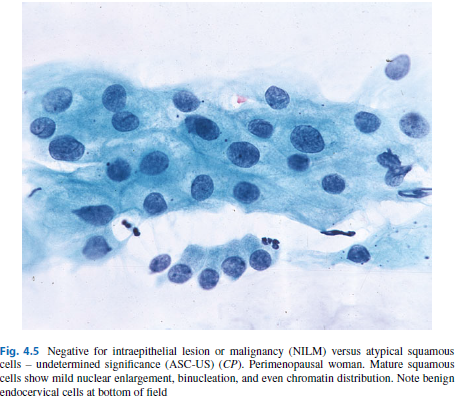 Traige Study ( ALTS) - HR HPV test