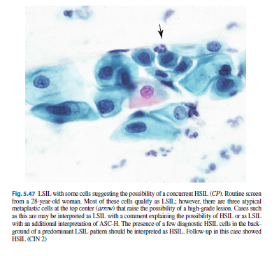 LSIL, ASC-H event.