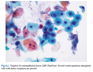 Anální cytologie incidence ca anu - 1,5/ 0,8/ 100 000 až 90% HPV