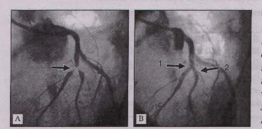 5 Wiktorův stent Obr.