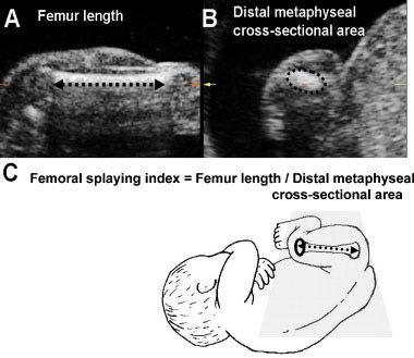 Předpokládané účinky vit D během těhotenství na plod -dle animálních i humánních studií mineralizace fetálního skeletu zejména Ca dependentní, vit D menší vliv x observační studie s 3D HR USG -