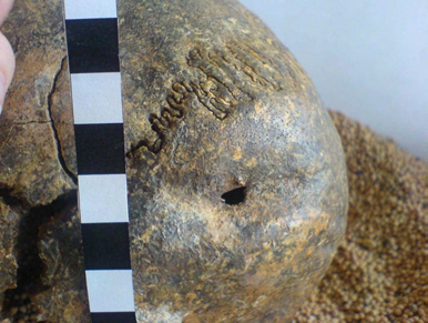 A B Obr. 25: Lebka muže z hrobu 18 z Řepčína se stopami po zranění. A pohled na lebku z boku, B detail zranění. Za zbraně používané v eneolitu lze považovat především kamenné sekeromlaty.