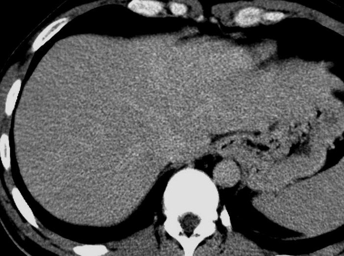 V CT obraze je FNH nativně hypodenzní. Po intravenózním podání kontrastní látky je typické homogenní sycení v arteriální fázi, aţ na střed loţiska ( centrální jizva ).