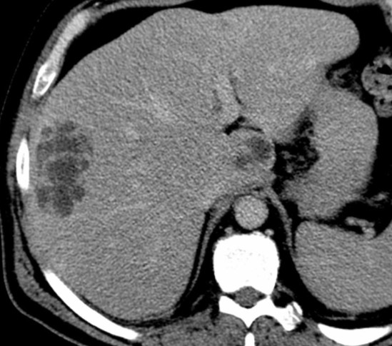 Pro primární diagnostiku není MR prakticky vyuţíváno, v úvahu přichází pouze u komplikovaných případů, u kterých nelze vyuţít ţádného typického rysu abscesové kolekce v diferenciální diagnóze /1/.