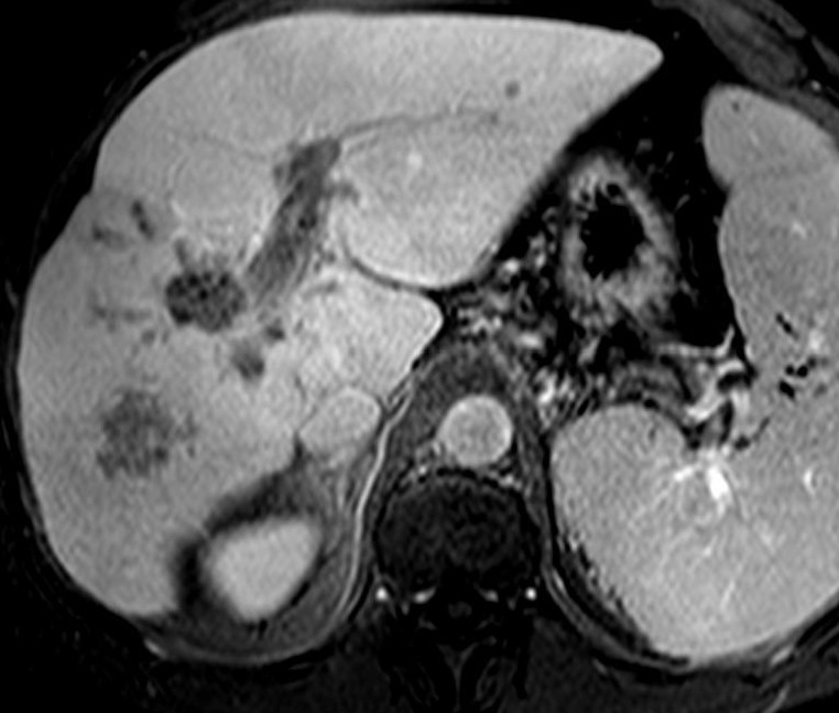 l. z loţiska (wash-out fenomén). V hepatospecifické fázi (dole) loţisko k.l. takřka nevychytává, oproti normálnímu jaternímu parenchymu je hypointenzní.