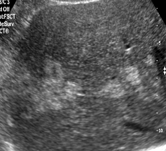 Parenchymové pseudoléze a) Fokální steatóza Steatóza jater postihuje cca 10% dospělé populace, incidence roste s věkem (častá metabolická komplikace toxických, metabolických, ischemických a