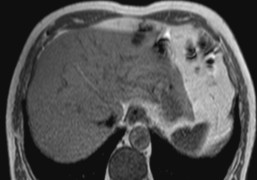 Etiologie je nejasná, je to ale důleţitá diferenciálně diagnostická jednotka, často je zaměňován s malignitami. US obraz je nespecifický, většinou je pseudotumor hypoechogenní či mozaikovitý,.