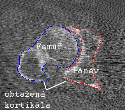 do modelářského softwaru CATIA V5R15.V tomto programu bylo vytvořeno ze sítí křivek plochy a následně ze sjednocených ploch vytvořen objem (příkaz close surface). Obr.10.2. Segmentace tkání Obr.10.3.