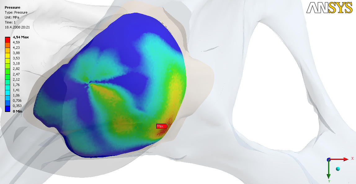 a) pohled shora b) pohled zepředu Obr.11.5. Kontaktní tlak na chrupavce femuru u kyčle po simulování operace Na obr 11.6.