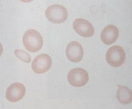 Hypochromní erytrocyty Velikost: < 6,5 μ Popis nižší