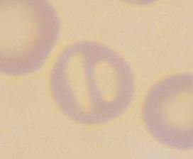 Knizocyty (bridge cells, pinched cells ) Popis most z hemoglobinu přes