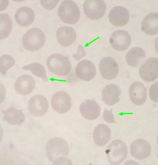 Schistocyty Klinický
