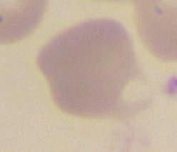 Keratocyty (blister cells, horn cells ) Popis ruptura nebo